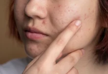 Benefits of Using Scars Neem Extract Facewash for Pimples