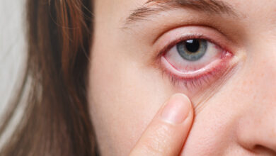 Healthy Strategies to Prevent Dry Eyes